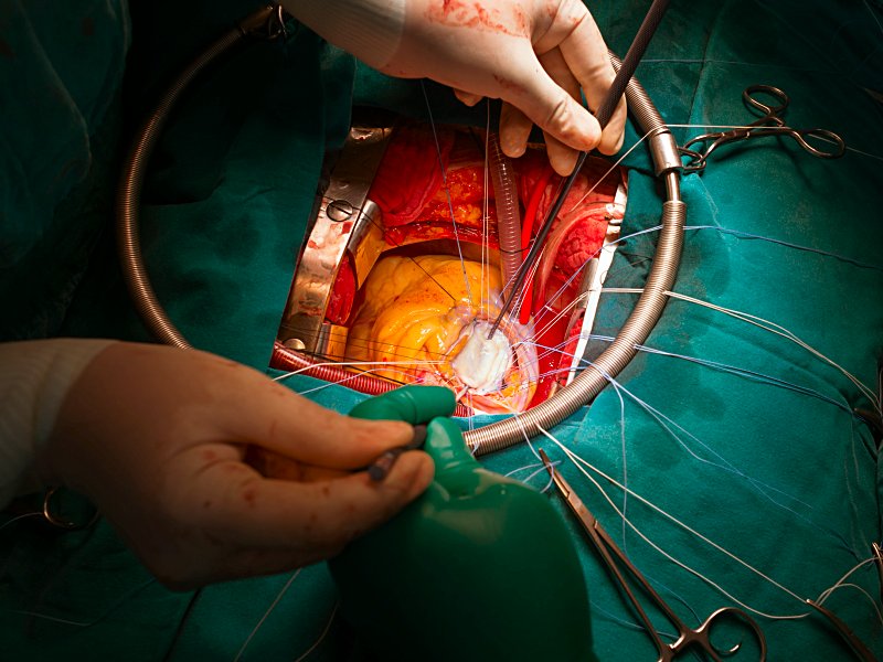 جراحی قلب جایگزینی دریچه