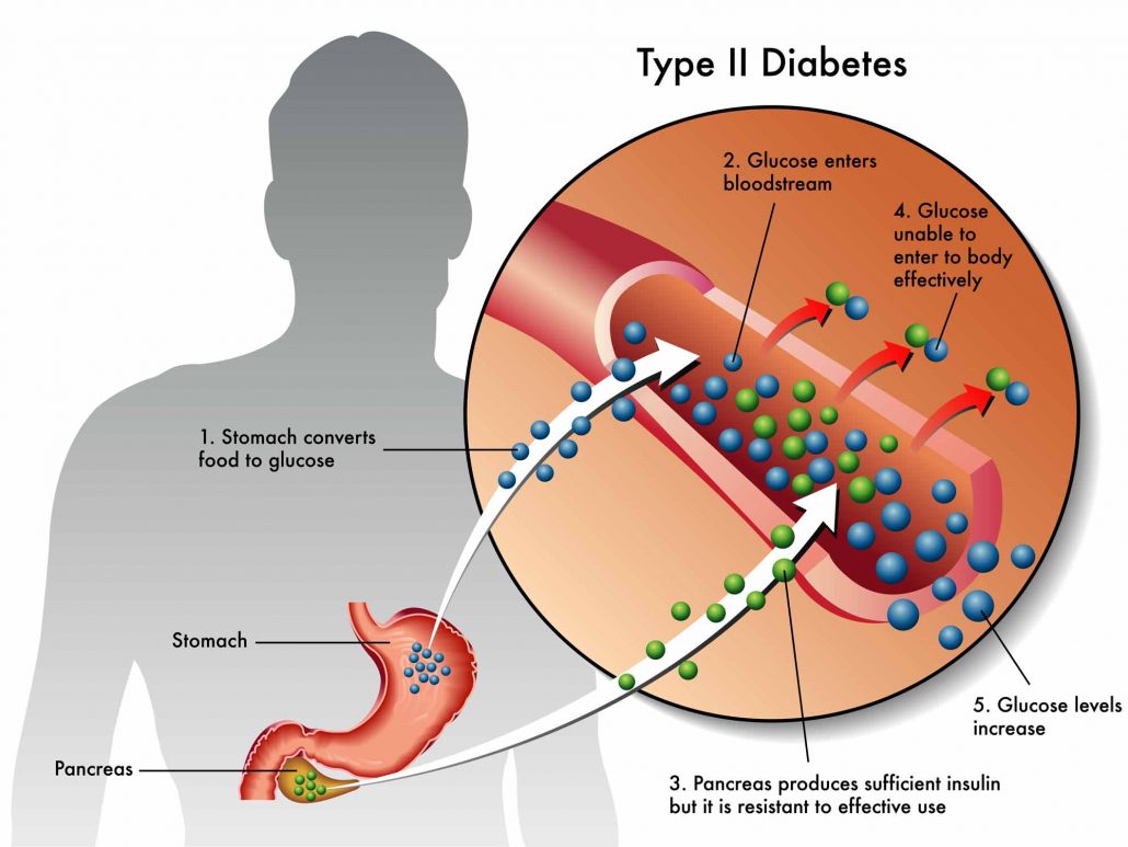 پیشگیری از دیابت نوع 2