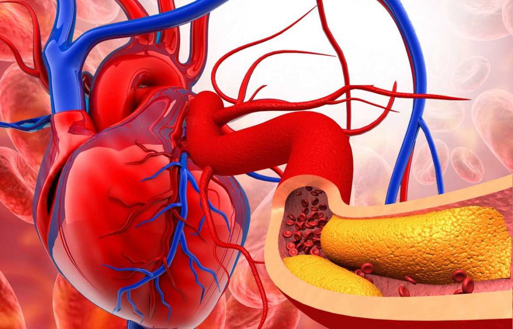 انژیوگرافی به دلیل تصلب شرایین