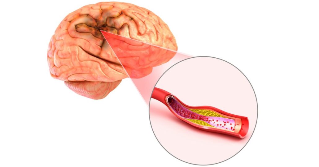 عکس لخته خون در مغز
